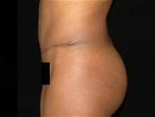 Tummy Tuck After Photo by Michelle Copeland, MD, DMD, FACS, PC; New York, NY - Case 25864