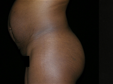 Tummy Tuck Before Photo by Michelle Copeland, MD, DMD, FACS, PC; New York, NY - Case 25864