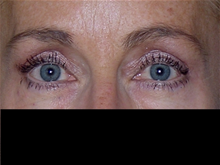Eyelid Surgery After Photo by Michelle Copeland, MD, DMD, FACS, PC; New York, NY - Case 25867