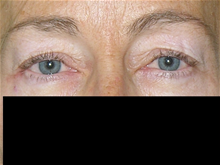 Eyelid Surgery Before Photo by Michelle Copeland, MD, DMD, FACS, PC; New York, NY - Case 25867