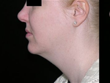 Liposuction Before Photo by Michelle Copeland, MD, DMD, FACS, PC; New York, NY - Case 25869