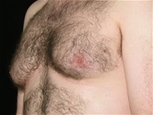 Male Breast Reduction Before Photo by Michelle Copeland, MD, DMD, FACS, PC; New York, NY - Case 25870