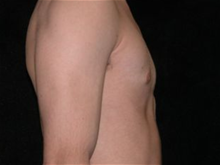 Male Breast Reduction After Photo by Michelle Copeland, MD, DMD, FACS, PC; New York, NY - Case 25872