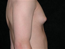 Male Breast Reduction Before Photo by Michelle Copeland, MD, DMD, FACS, PC; New York, NY - Case 25872
