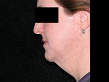 Liposuction Before Photo by Michelle Copeland, MD, DMD, FACS, PC; New York, NY - Case 25874