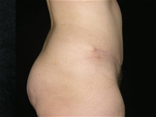 Tummy Tuck After Photo by Michelle Copeland, MD, DMD, FACS, PC; New York, NY - Case 25875