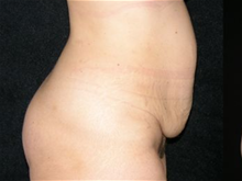 Tummy Tuck Before Photo by Michelle Copeland, MD, DMD, FACS, PC; New York, NY - Case 25875