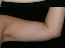 Liposuction After Photo by Michelle Copeland, MD, DMD, FACS, PC; New York, NY - Case 25876
