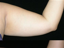 Liposuction Before Photo by Michelle Copeland, MD, DMD, FACS, PC; New York, NY - Case 25876