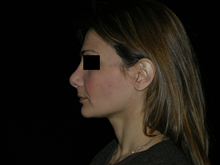 Rhinoplasty After Photo by Michelle Copeland, MD, DMD, FACS, PC; New York, NY - Case 25878