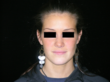 Rhinoplasty After Photo by Michelle Copeland, MD, DMD, FACS, PC; New York, NY - Case 25879