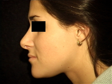 Rhinoplasty After Photo by Michelle Copeland, MD, DMD, FACS, PC; New York, NY - Case 25880