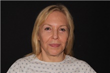 Facelift After Photo by Michelle Copeland, MD, DMD, FACS, PC; New York, NY - Case 38901