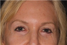 Eyelid Surgery After Photo by Michelle Copeland, MD, DMD, FACS, PC; New York, NY - Case 38902