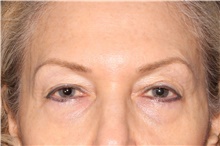Eyelid Surgery Before Photo by Michelle Copeland, MD, DMD, FACS, PC; New York, NY - Case 38902