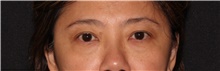 Eyelid Surgery Before Photo by Michelle Copeland, MD, DMD, FACS, PC; New York, NY - Case 40626