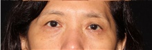 Eyelid Surgery After Photo by Michelle Copeland, MD, DMD, FACS, PC; New York, NY - Case 40627