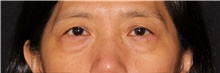 Eyelid Surgery Before Photo by Michelle Copeland, MD, DMD, FACS, PC; New York, NY - Case 40627