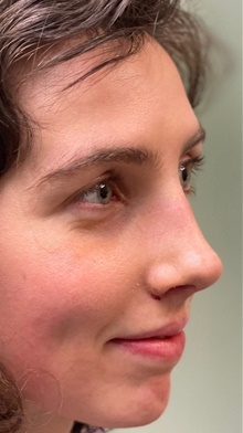 Rhinoplasty After Photo by Michelle Copeland, MD, DMD, FACS, PC; New York, NY - Case 42711