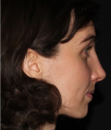 Rhinoplasty After Photo by Michelle Copeland, MD, DMD, FACS, PC; New York, NY - Case 42711