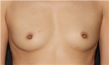 Breast Augmentation Before Photo by Michelle Copeland, MD, DMD, FACS, PC; New York, NY - Case 43099