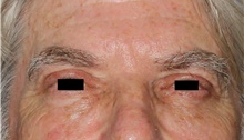 Eyelid Surgery After Photo by Michelle Copeland, MD, DMD, FACS, PC; New York, NY - Case 43101