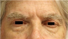 Eyelid Surgery Before Photo by Michelle Copeland, MD, DMD, FACS, PC; New York, NY - Case 43101