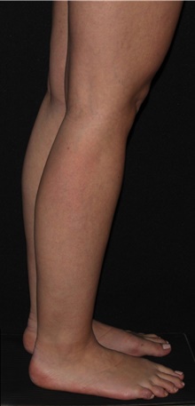 Liposuction Before Photo by Michelle Copeland, MD, DMD, FACS, PC; New York, NY - Case 43598