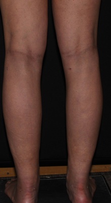 Liposuction After Photo by Michelle Copeland, MD, DMD, FACS, PC; New York, NY - Case 43598