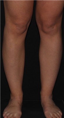 Liposuction Before Photo by Michelle Copeland, MD, DMD, FACS, PC; New York, NY - Case 43598