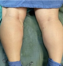 Calf Augmentation After Photo by Michelle Copeland, MD, DMD, FACS, PC; New York, NY - Case 44761