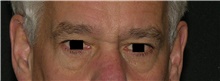 Eyelid Surgery Before Photo by Michelle Copeland, MD, DMD, FACS, PC; New York, NY - Case 44805
