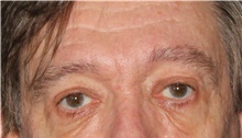 Eyelid Ptosis Repair After Photo by Michelle Copeland, MD, DMD, FACS, PC; New York, NY - Case 46007