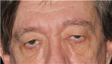 Eyelid Ptosis Repair Before Photo by Michelle Copeland, MD, DMD, FACS, PC; New York, NY - Case 46007