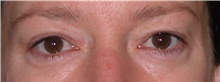 Eyelid Surgery Before Photo by Michelle Copeland, MD, DMD, FACS, PC; New York, NY - Case 46650