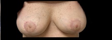 Breast Implant Removal After Photo by Michelle Copeland, MD, DMD, FACS, PC; New York, NY - Case 46652