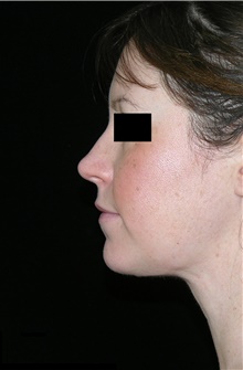 Neck Lift After Photo by Michelle Copeland, MD, DMD, FACS, PC; New York, NY - Case 46665