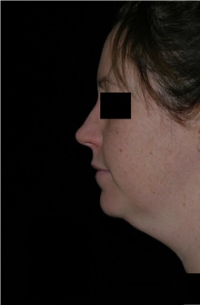 Neck Lift Before Photo by Michelle Copeland, MD, DMD, FACS, PC; New York, NY - Case 46665