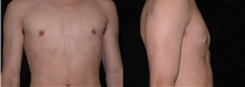 Male Breast Reduction After Photo by Michelle Copeland, MD, DMD, FACS, PC; New York, NY - Case 46673