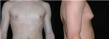 Male Breast Reduction Before Photo by Michelle Copeland, MD, DMD, FACS, PC; New York, NY - Case 46673