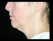 Neck Lift Before Photo by Michelle Copeland, MD, DMD, FACS, PC; New York, NY - Case 46914