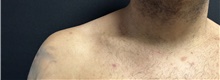 Liposuction After Photo by Michelle Copeland, MD, DMD, FACS, PC; New York, NY - Case 46974