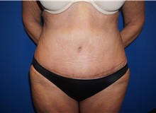 Tummy Tuck After Photo by Niki Christopoulos, MD, FACS; Chicago, IL - Case 35271