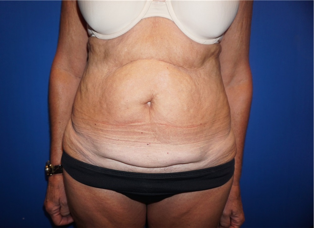 Tummy Tuck Before and After Photos by Niki Christopoulos, MD, FACS; Chicago,  IL - Case 35271