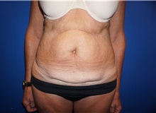 Tummy Tuck Before Photo by Niki Christopoulos, MD, FACS; Chicago, IL - Case 35271