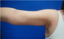 Arm Lift After Photo by Niki Christopoulos, MD, FACS; Chicago, IL - Case 35272