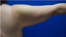 Arm Lift Before Photo by Niki Christopoulos, MD, FACS; Chicago, IL - Case 35272