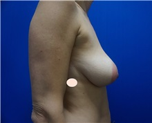 Breast Lift Before Photo by Niki Christopoulos, MD, FACS; Chicago, IL - Case 35273