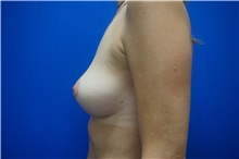 Breast Lift After Photo by Niki Christopoulos, MD, FACS; Chicago, IL - Case 35273