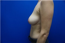 Breast Lift Before Photo by Niki Christopoulos, MD, FACS; Chicago, IL - Case 35273